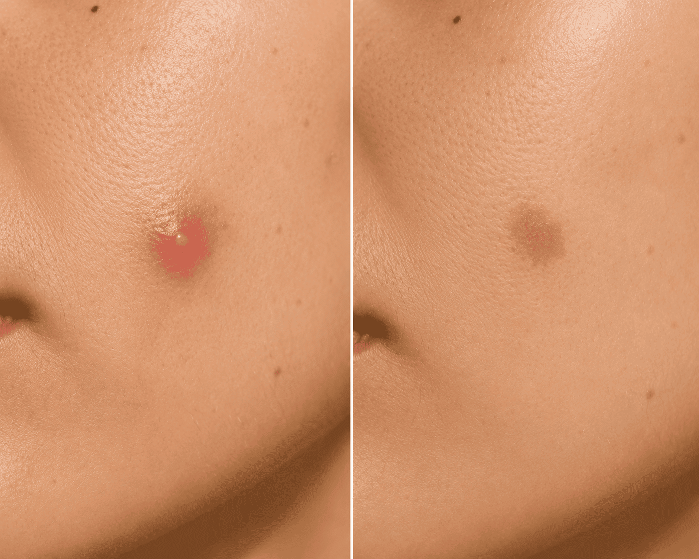 Before and after mole removal on skin for clear complexion.